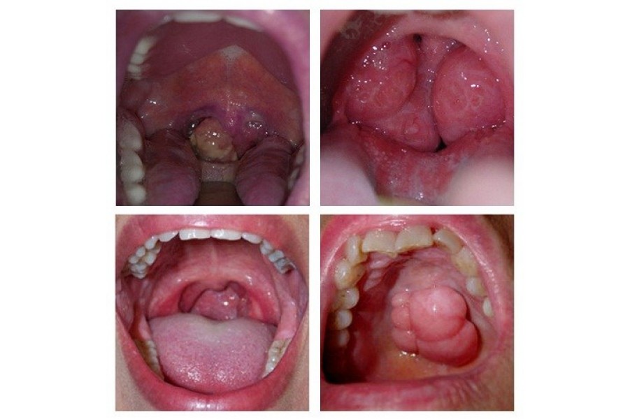 Chữa bệnh ung thư vòm họng