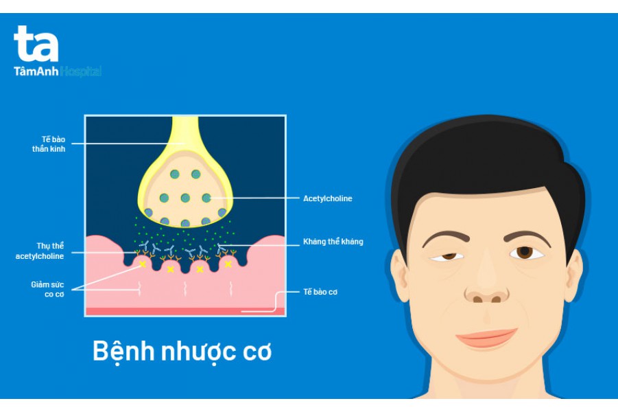 Cách chữa bệnh Nhược cơ hiệu quả cao