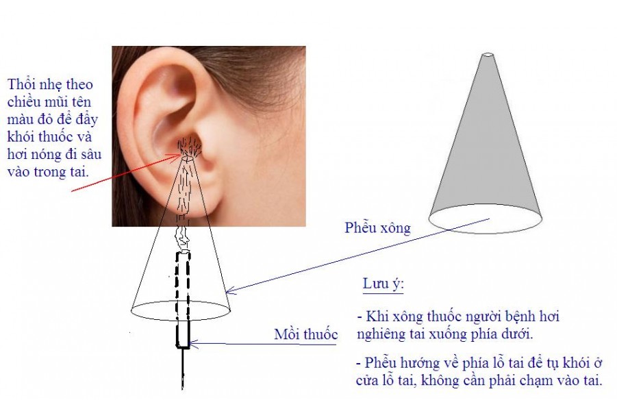 Viêm tai giữa cấp là gì?