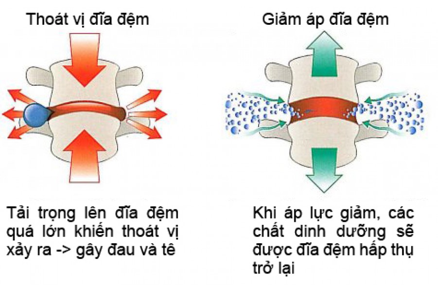 Trị bệnh thoát vị đĩa đệm