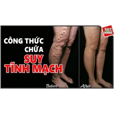 masage đã thông chữa bệnh Suy giãn tĩnh mạch