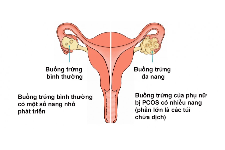 Chữa bệnh Đa nang, u nang buồng trứng và vô sinh nữ