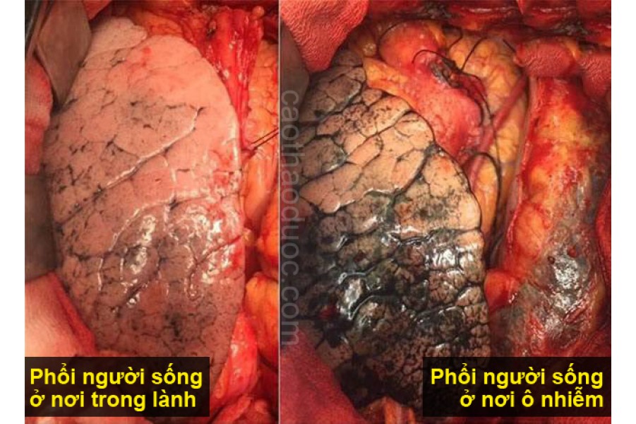 Các thực phẩm kỵ và cần dùng cho người bệnh phổi