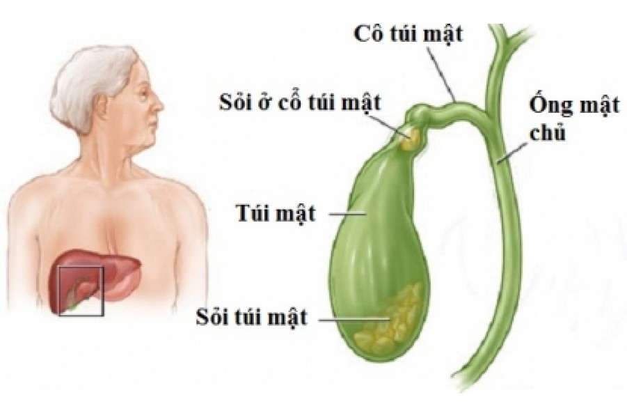 ‘Kì diệu’ tống 40-50 viên sỏi mật chỉ trong vòng 6 ngày mà không cần phải mổ