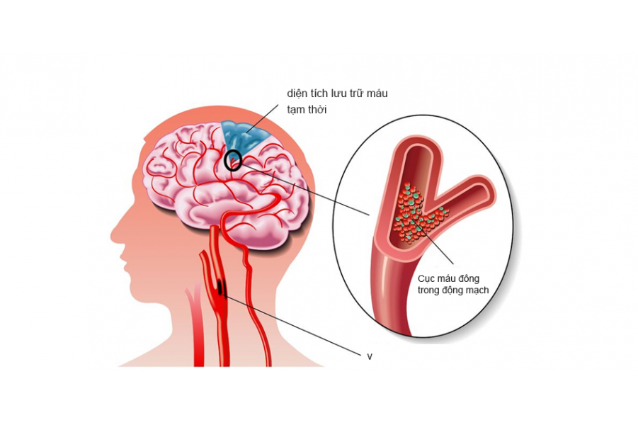 Trị bệnh thiếu máu não