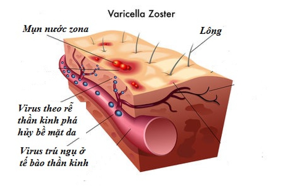 Tìm Hiểu Về Virus Gây Bệnh Thủy Đậu Và Zona Thần Kinh