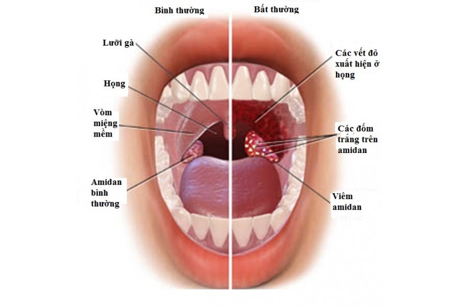 Chữa bệnh Viêm Amidan mãn tính.