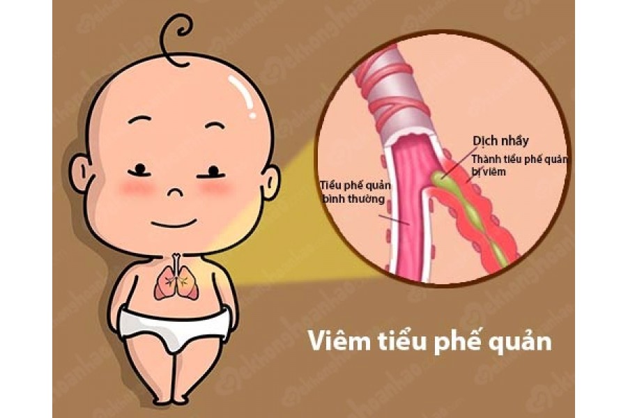 Viêm phế quản mạn tính